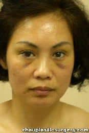 Brow Lift for Asian Woman
