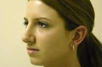 Rhinoplasty for Young Female