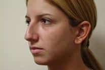 Rhinoplasty for Young Female