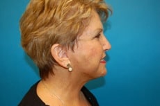 Chin Augmentation on Female Patient