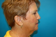 Chin Augmentation on Female Patient