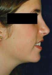 Chin Augmentation for Enhanced Appearance