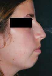Chin Augmentation for Enhanced Appearance