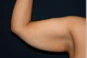 Brachioplasty (Arm Lift) for Female Patient