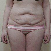 Tummy Tuck for 26-Year-Old Woman