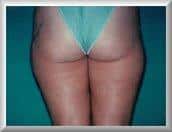 Liposuction of the Outer Thighs on 38 Year Old Woman