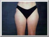 33 Year Old Female Liposuction of the Outer Thighs