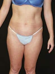 Liposuction and Tummy Tuck