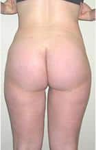 Buttock Implant Surgery & Tumscent Liposuction