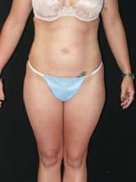 Wonderful Results From Mini Tummy Tuck & Liposuction