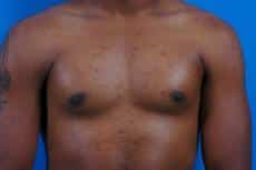 Male Breast Reduction for a More Tone Appearance
