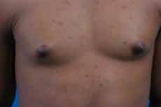 Male Breast Reduction for a More Tone Appearance