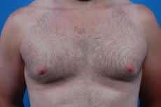 Phenomenal Male Breast Reduction