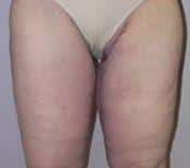 Female Patient Undergoes Thigh Lift