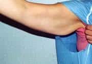 Arm Lift for Female Patient